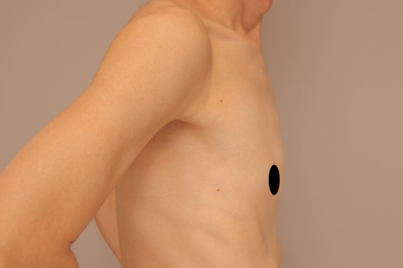 ベイザー脂肪吸引（８か月後経過：50）の術前写真