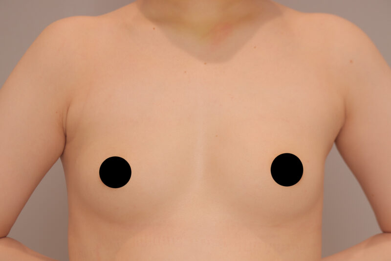 ベイザー脂肪吸引（１年半後経過：28）の術前写真