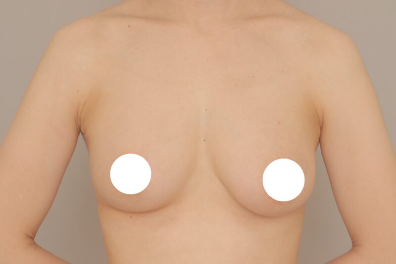 ベイザー脂肪吸引(1ヶ月経過:38)の術後写真