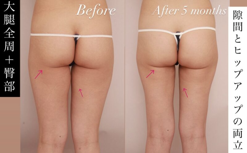【もう隠さない！】太もも・お尻の脂肪吸引で実現した「隙間」と「ヒップアップ」の両立