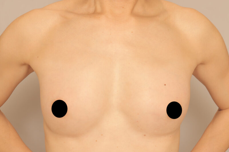 ベイザー脂肪吸引（13ヶ月後経過：50）の術後写真