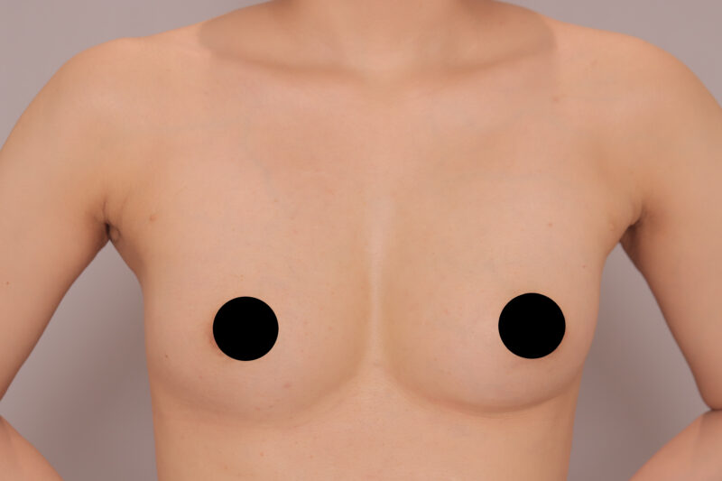 ベイザー脂肪吸引（8ヶ月後経過：35）の術後写真