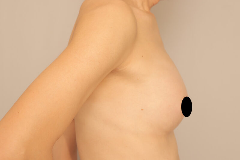 ベイザー脂肪吸引（８か月後経過：50）の術後写真