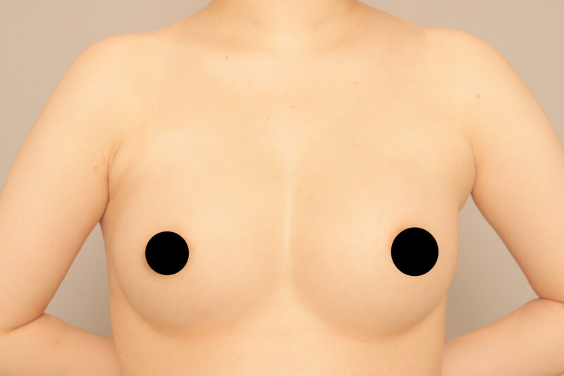 ベイザー脂肪吸引（１年半後経過：28）の術後写真