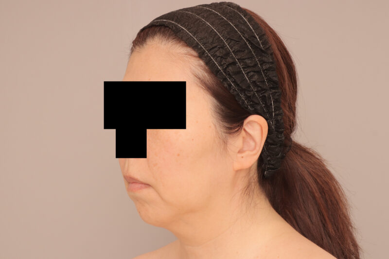 ベイザー脂肪吸引（半年後経過：56）の術前写真