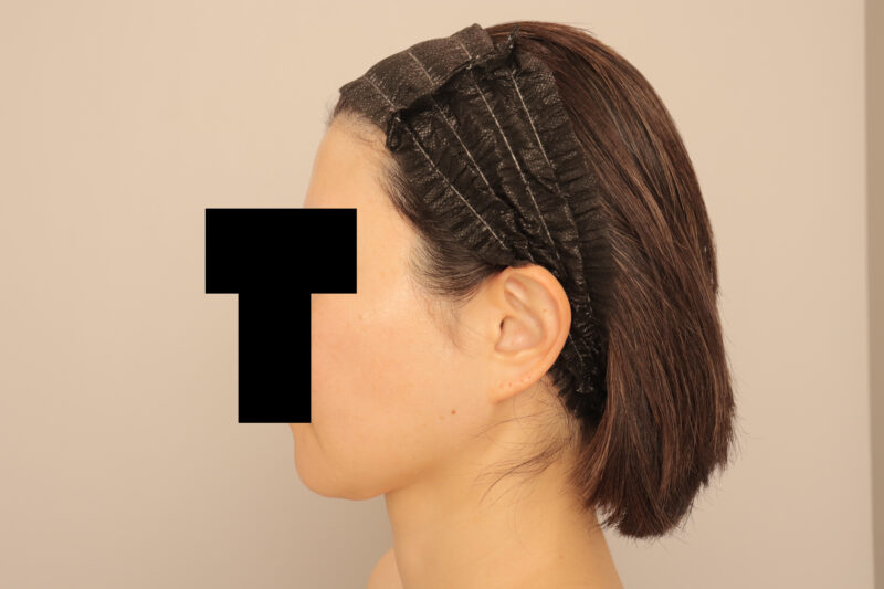 頬顎脂肪吸引でフェイスラインをスッキリさせてより洗練された印象に♡