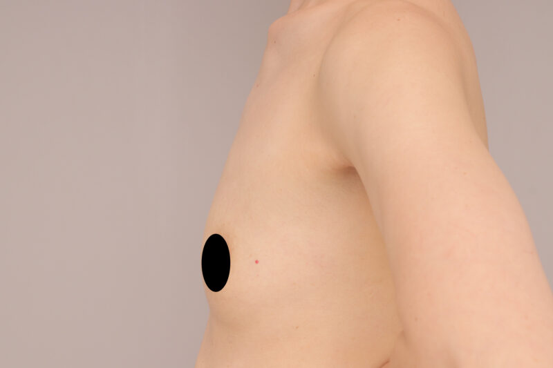 ベイザー脂肪吸引（半年後経過：39）の術前写真