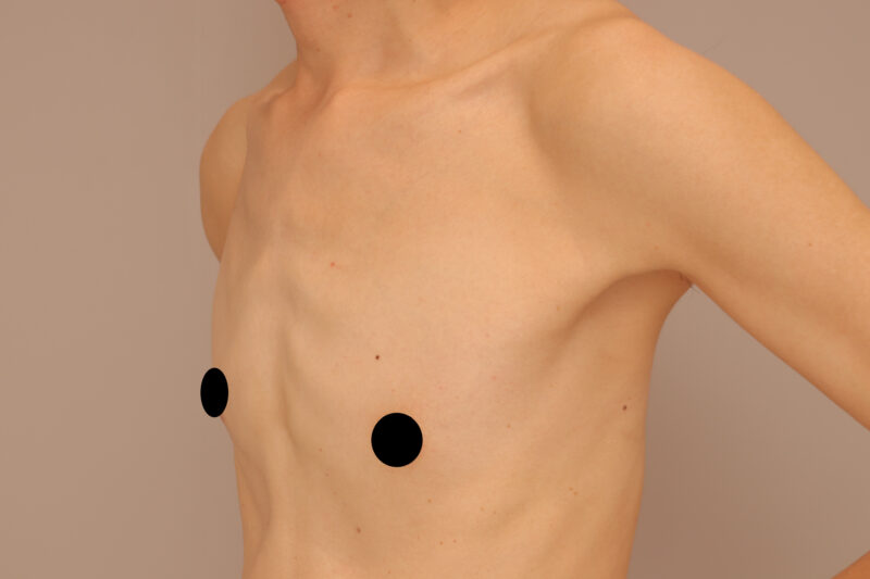 ベイザー脂肪吸引（13ヶ月後経過：50）の術前写真