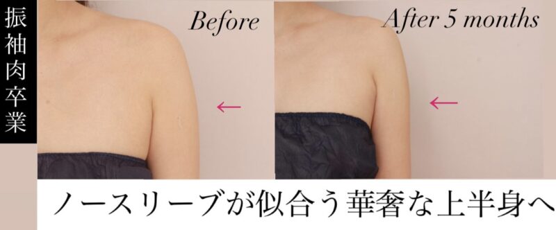 【「振袖肉」卒業！】肩から二の腕へのラインを整えて、ノースリーブが似合う華奢な上半身へ