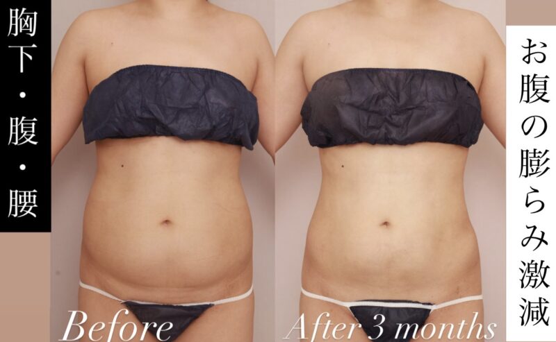 【お腹の膨らみ激減】体幹がコンパクトになることで全身のスタイルアップ効果を実感！