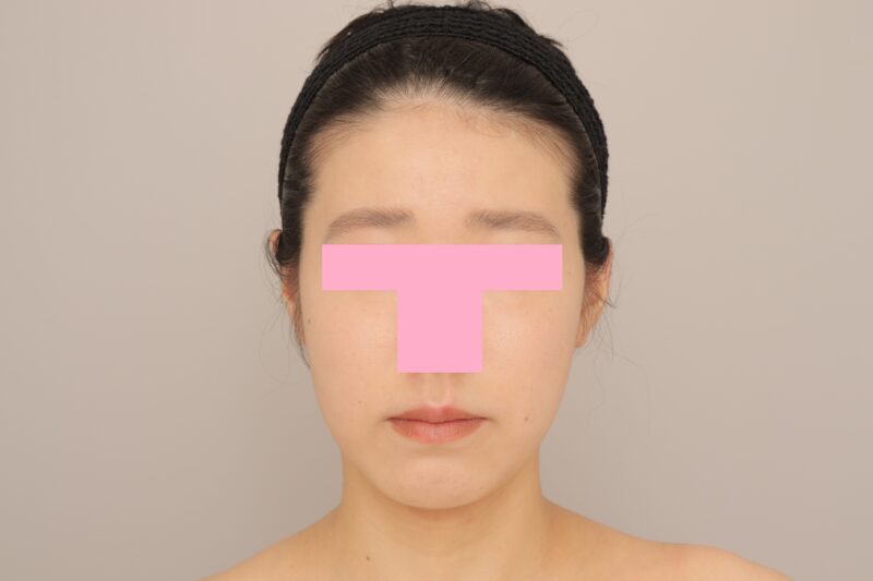 ベイザー脂肪吸引（6か月経過：28）の術後写真