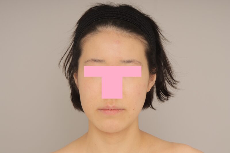 ベイザー脂肪吸引（6か月経過：28）の術前写真