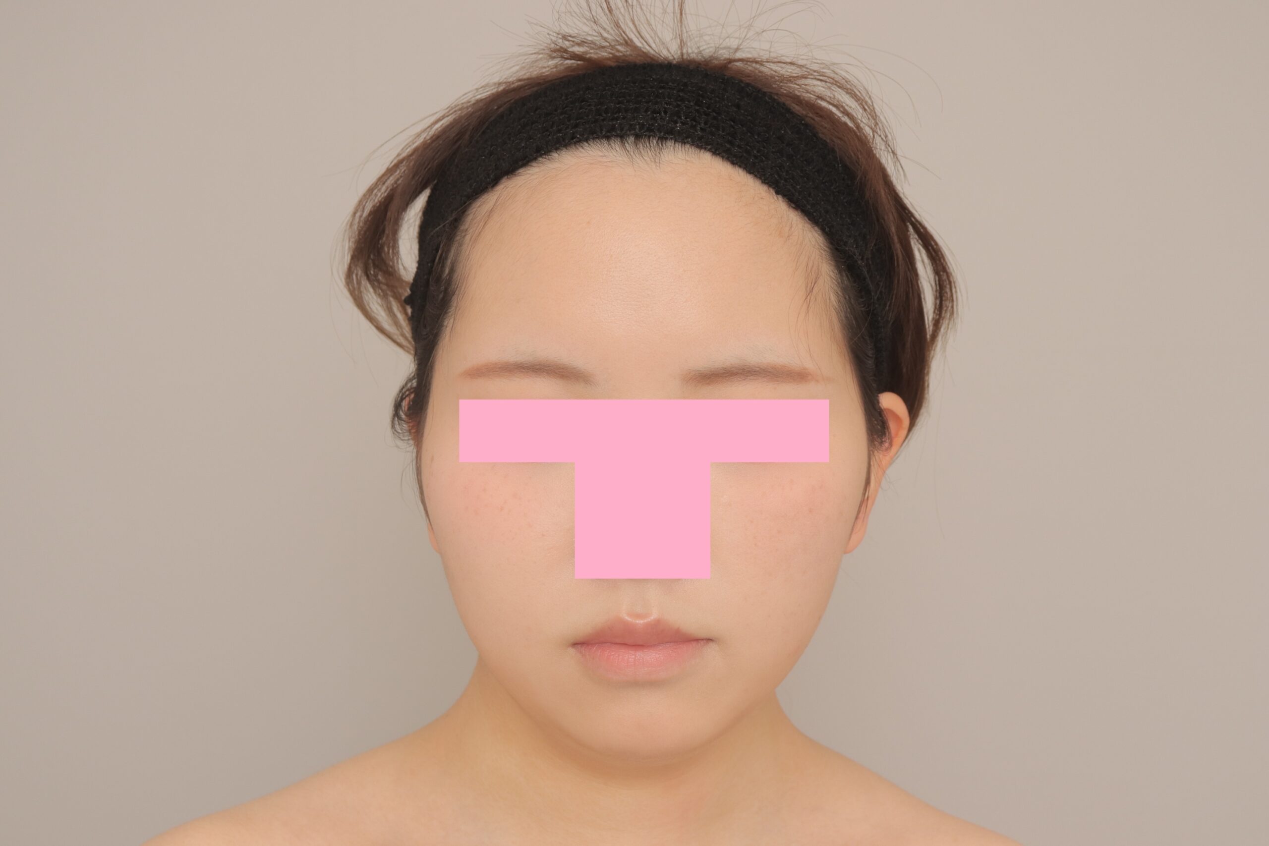 ベイザー脂肪吸引（6か月経過：19）の術後写真