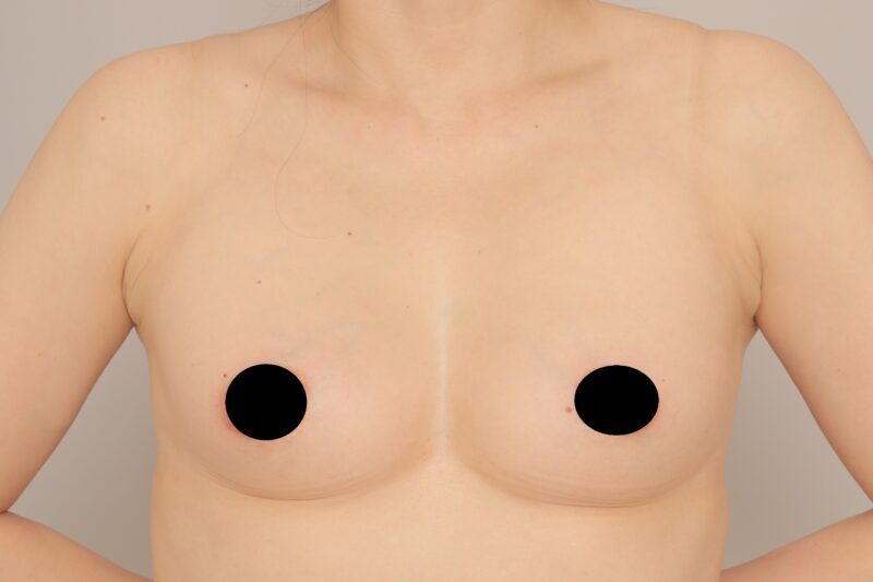 ベイザー脂肪吸引（6か月経過：44）の術後写真