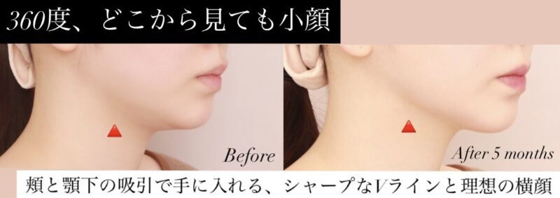 【360度、どこから見ても小顔】脂肪吸引で手に入れる、シャープなVラインと理想の横顔