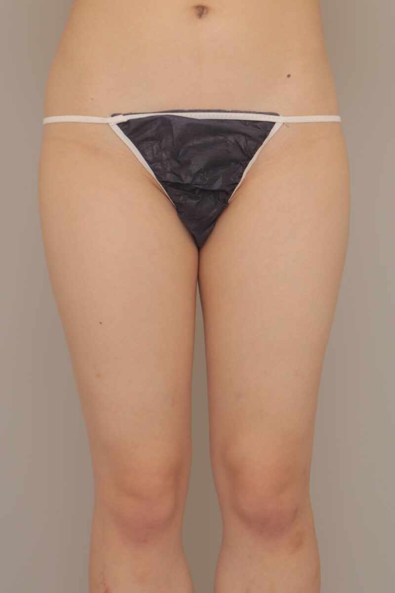 ベイザー脂肪吸引（3ヶ月経過：18）の術前写真