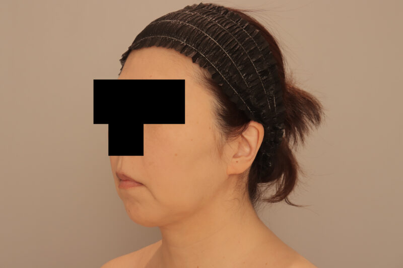 ベイザー脂肪吸引（半年後経過：56）の術後写真