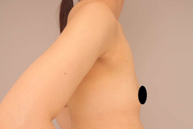 ベイザー脂肪吸引（8ヶ月後経過：35）の術前写真