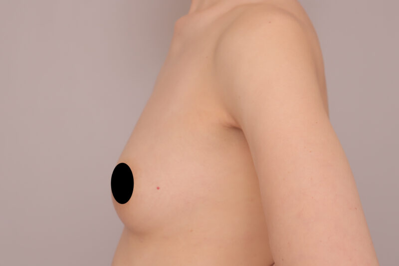 ベイザー脂肪吸引（半年後経過：39）の術後写真