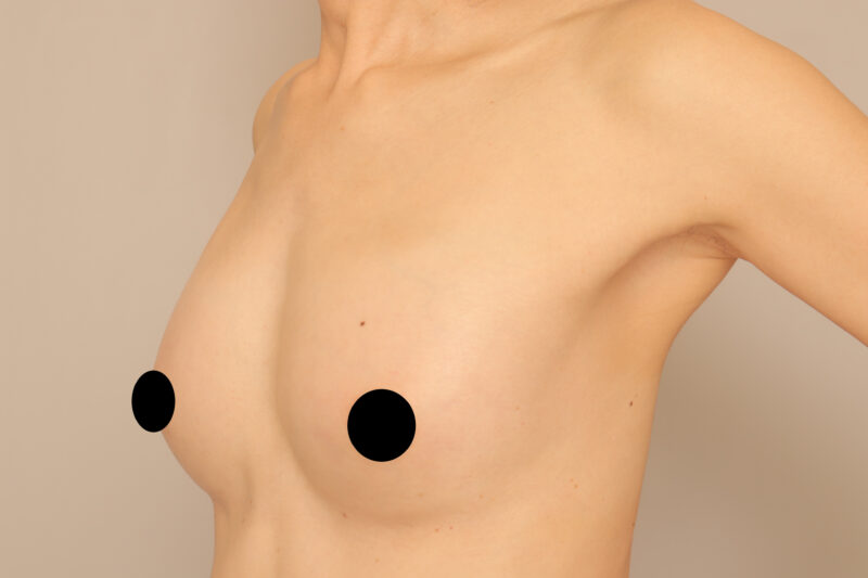 ベイザー脂肪吸引（13ヶ月後経過：50）の術後写真