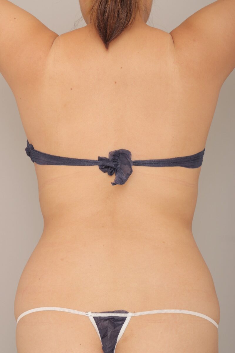 ベイザー脂肪吸引（6か月経過：35）の術前写真