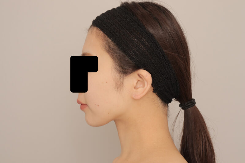 ベイザー脂肪吸引（６か月経過：25）の術後写真