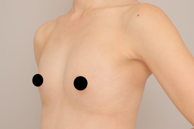 ベイザー脂肪吸引（1ヵ月経過：29）の術後写真