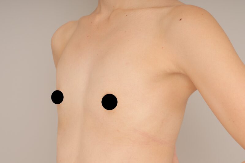 ベイザー脂肪吸引（1ヵ月経過：29）の術前写真