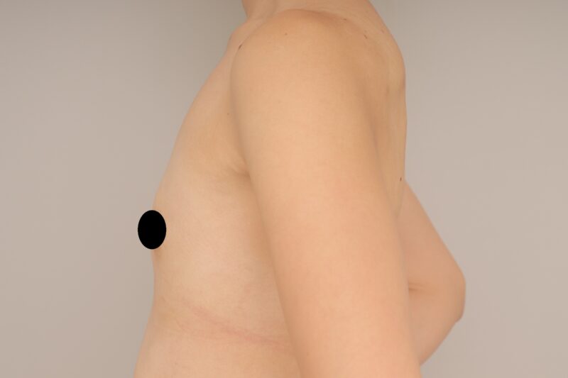 ベイザー脂肪吸引（1か月経過：29）の術前写真