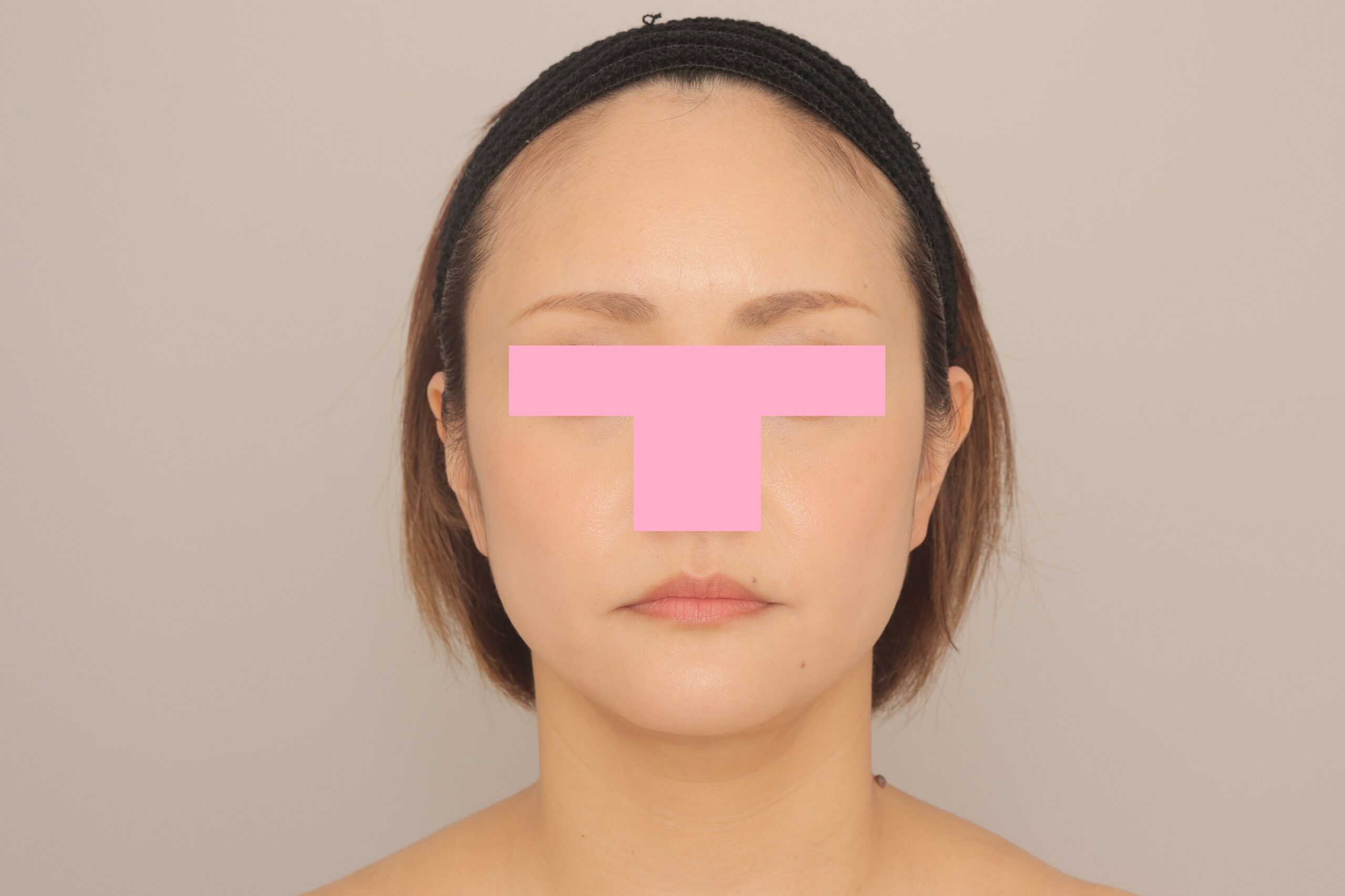 ベイザー脂肪吸引（3か月経過：39）の術後写真