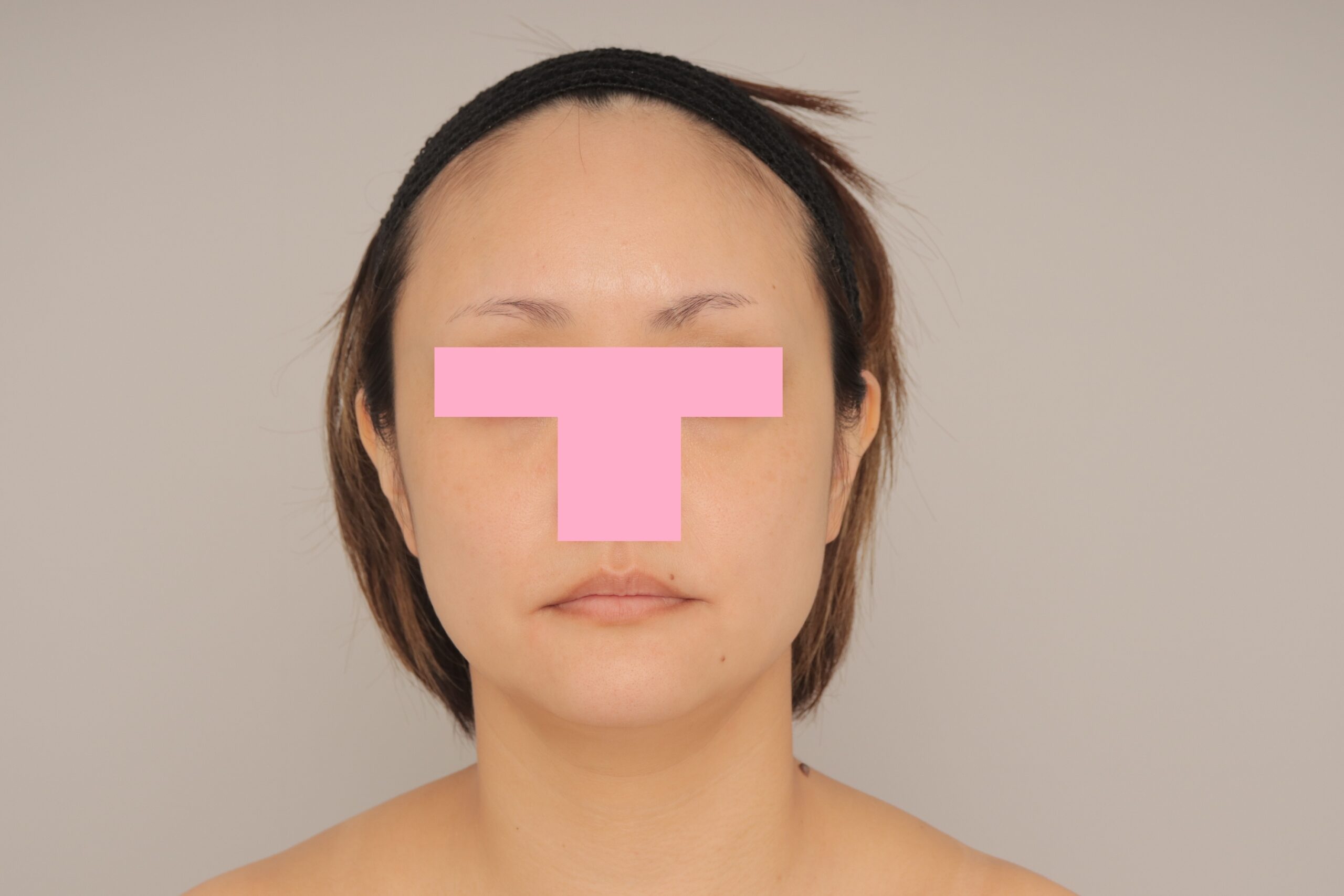 ベイザー脂肪吸引（3か月経過：39）の術前写真