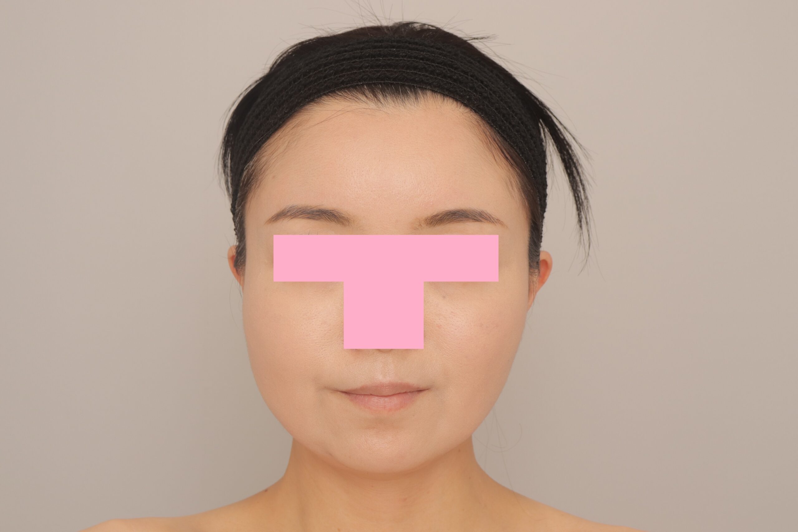 ベイザー脂肪吸引（3か月経過：45）の術後写真