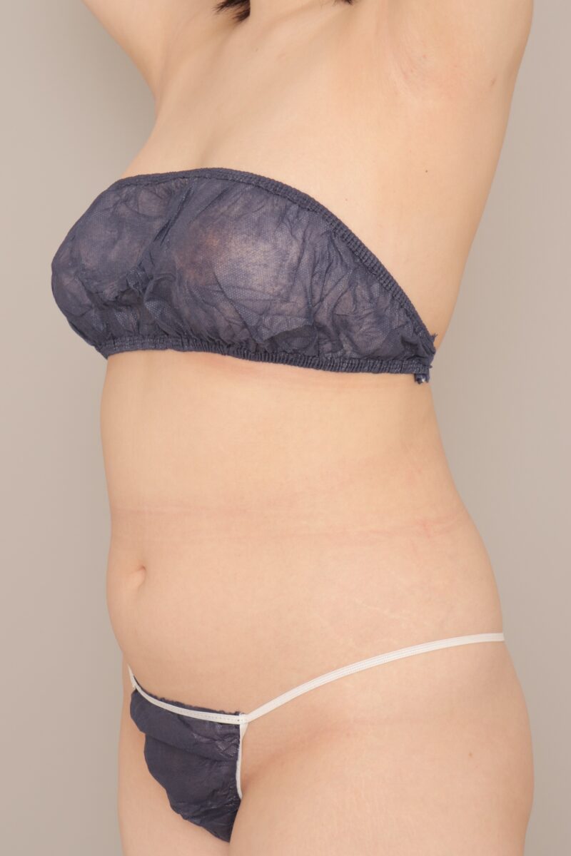 ベイザー脂肪吸引（1ヵ月経過：28）の術前写真