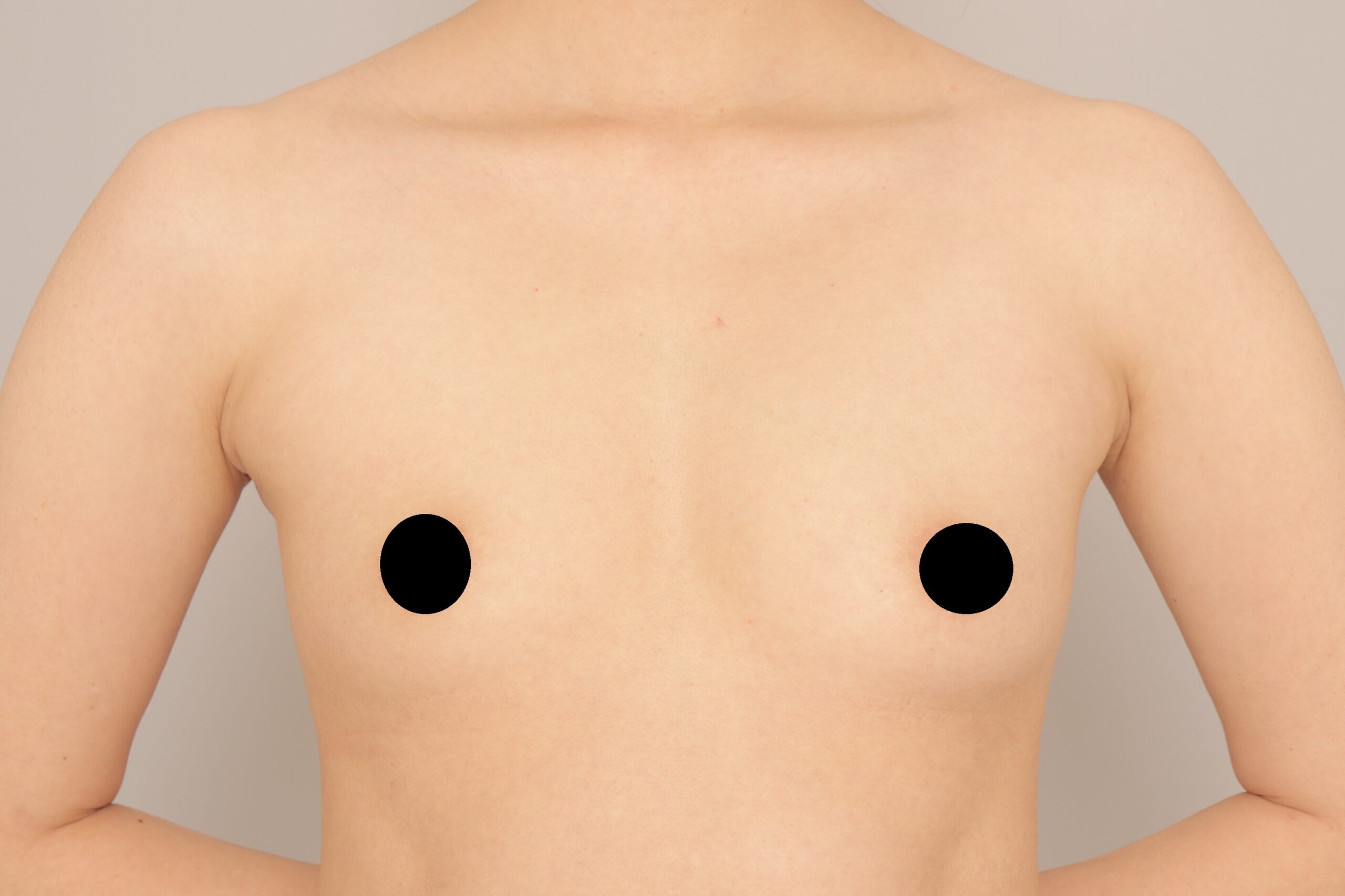 ベイザー脂肪吸引（1ヵ月経過：37）の術前写真