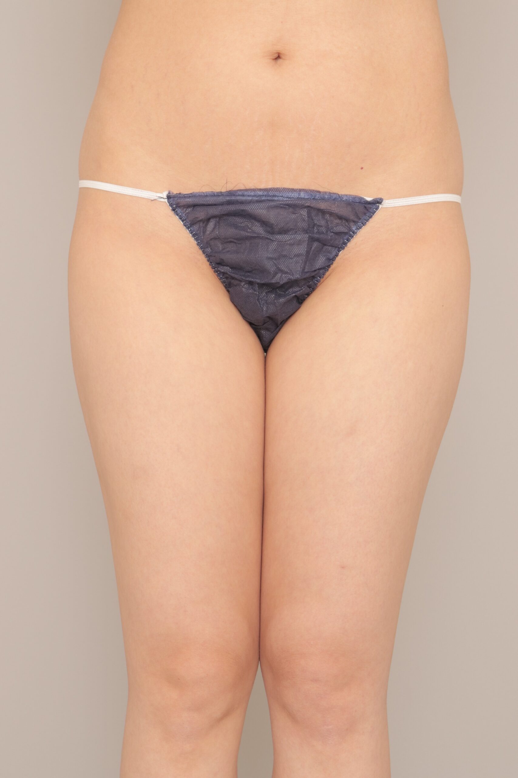 ベイザー脂肪吸引（1ヵ月経過：38）の術前写真