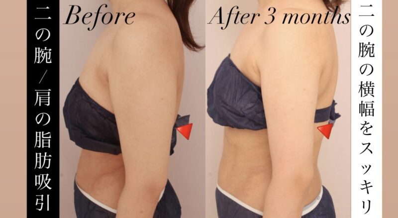 【二の腕+肩】二の腕の横幅が減り全体のボリュームがスッキリ！