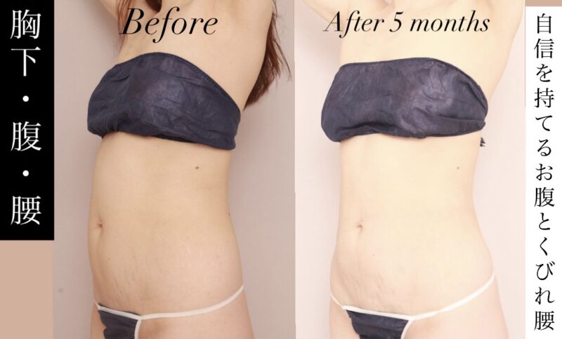 【もう『ぽっこりお腹』に悩まない！】自信を持てるフラットなお腹とくびれ腰