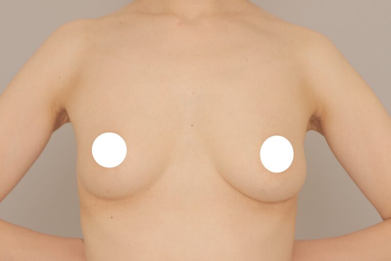 ベイザー脂肪吸引(1ヶ月経過:38)の術前写真