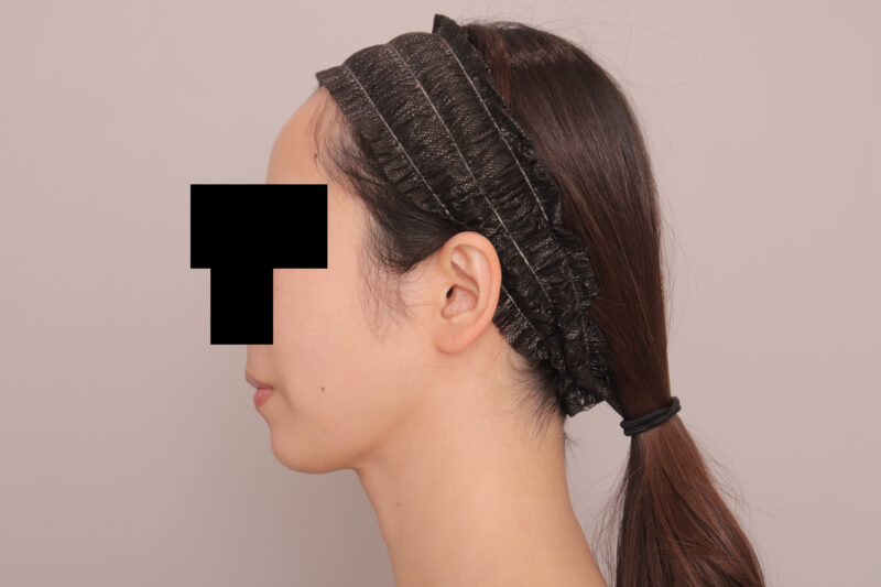 ベイザー脂肪吸引（３か月後経過：32）の術後写真