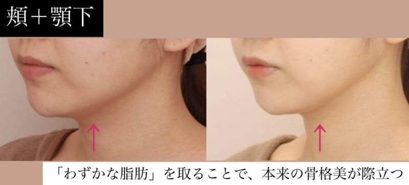 【「あと少し」を追求！】「わずかな脂肪」を取ることで、本来の骨格美が際立つ