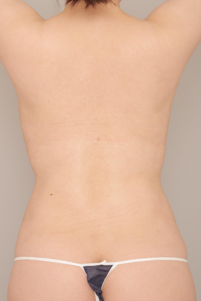 ベイザー脂肪吸引（6か月経過：25）の術後写真