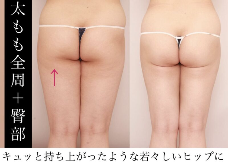 【「隙間」と「上がり」で脚長効果】キュッと持ち上がったような若々しいヒップラインに