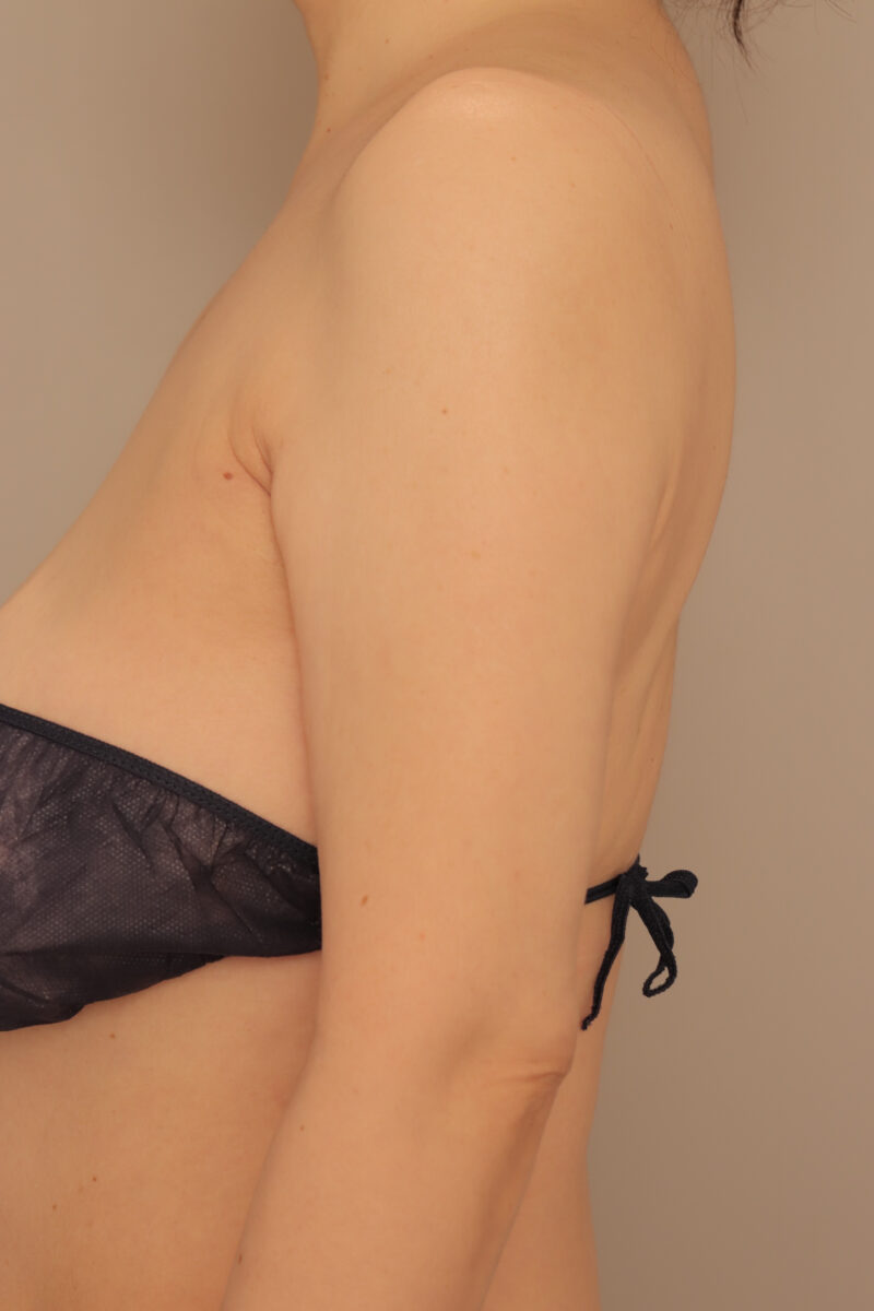 ベイザー脂肪吸引（半年後経過：56）の術後写真