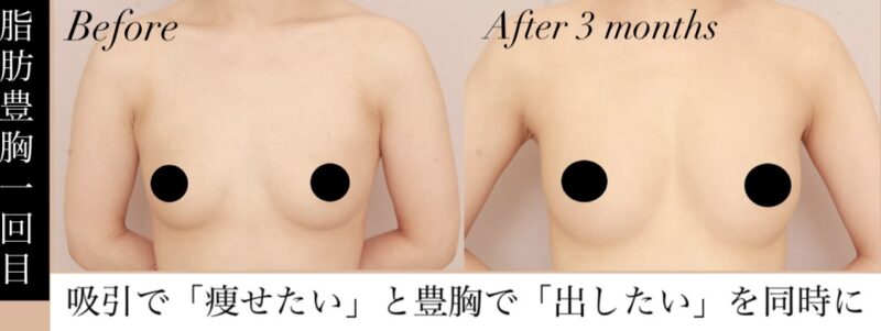 【「痩せたい」と「出したい」を同時に】脂肪豊胸で人工物にはない「圧倒的な自然さ」を