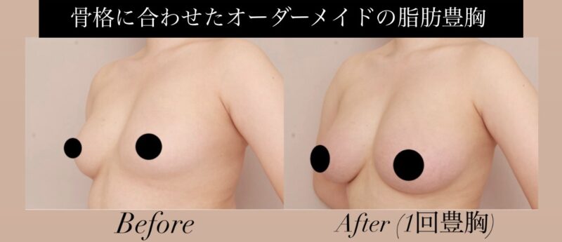 【骨格ストレート×脂肪豊胸（1回）】骨格に合わせたオーダーメイドの脂肪豊胸が可能です！