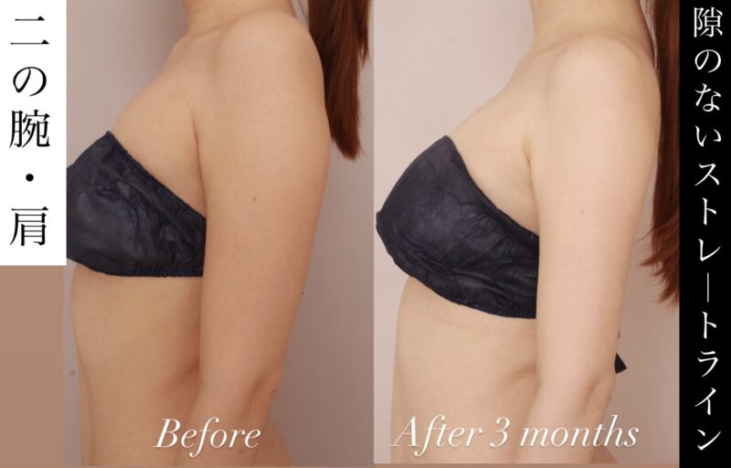 【360度どこから見ても美しい！】脂肪吸引で手に入れた隙のない究極ストレートライン