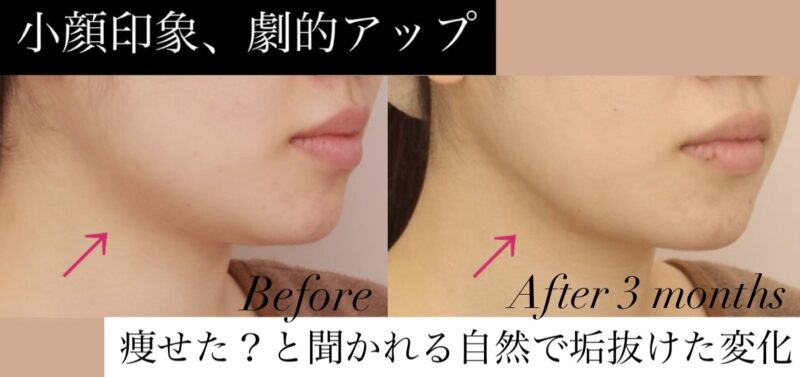 【「小顔印象」劇的アップ！】「痩せた？」と聞かれる自然で垢抜けた変化