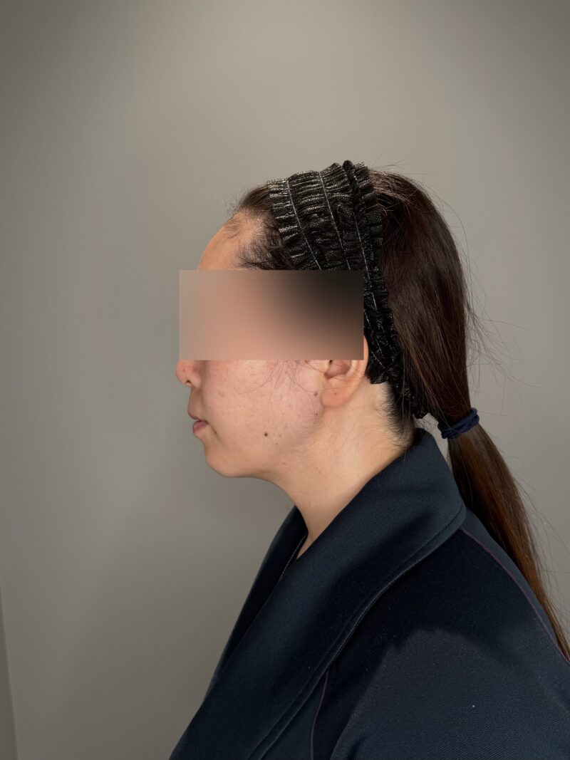 ベイザー脂肪吸引（術後３ヶ月経過：32）の術後写真