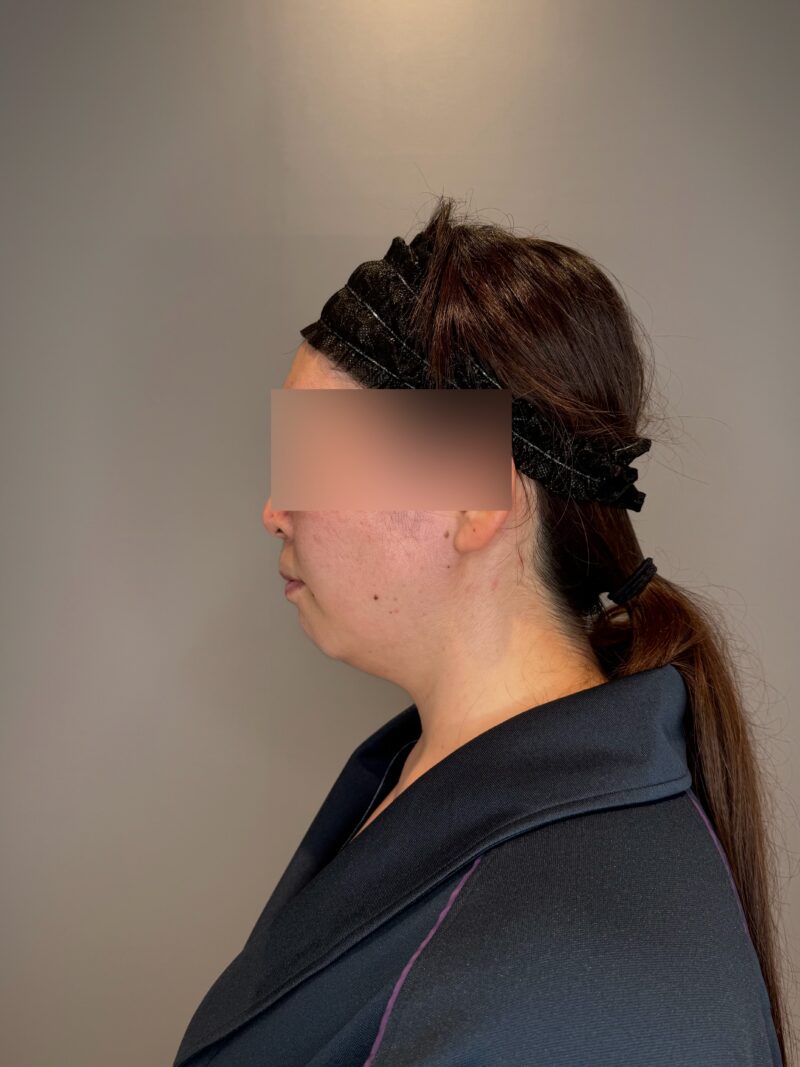 ベイザー脂肪吸引（術後３ヶ月経過：32）の術前写真