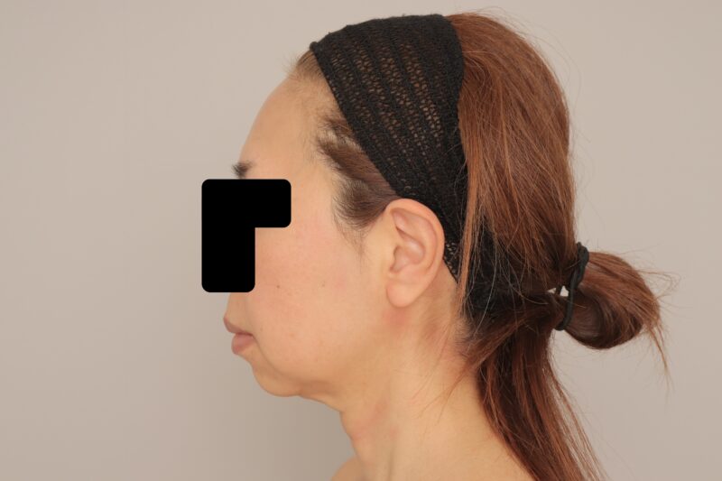 ベイザー脂肪吸引（１ヶ月経過：52）の術前写真